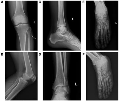 Frontiers Nonoperative treatment of avulsion fracture of the